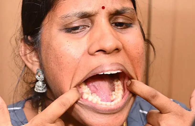 2023 인체 기네스에 소개된 일반인보다 6개나 더 많은 38개의 치아를 보유한 인도 여성. 사진=기네스 월드 레코드